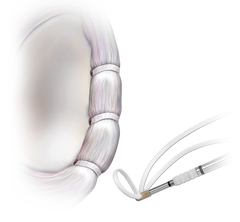 Arthrex - #2 FiberLink Suture with Closed Loop, 26 inches
